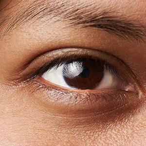 Dark Circles Treatment