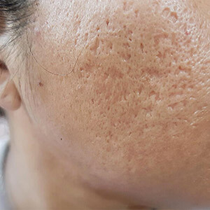 Large Pores/Scars Solution