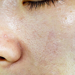 Oil & Sebum Control