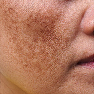 Pigmentation/ Melasma Solution