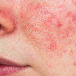 Redness/ Rashes Solution