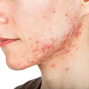 Spot & Blemish Treatment